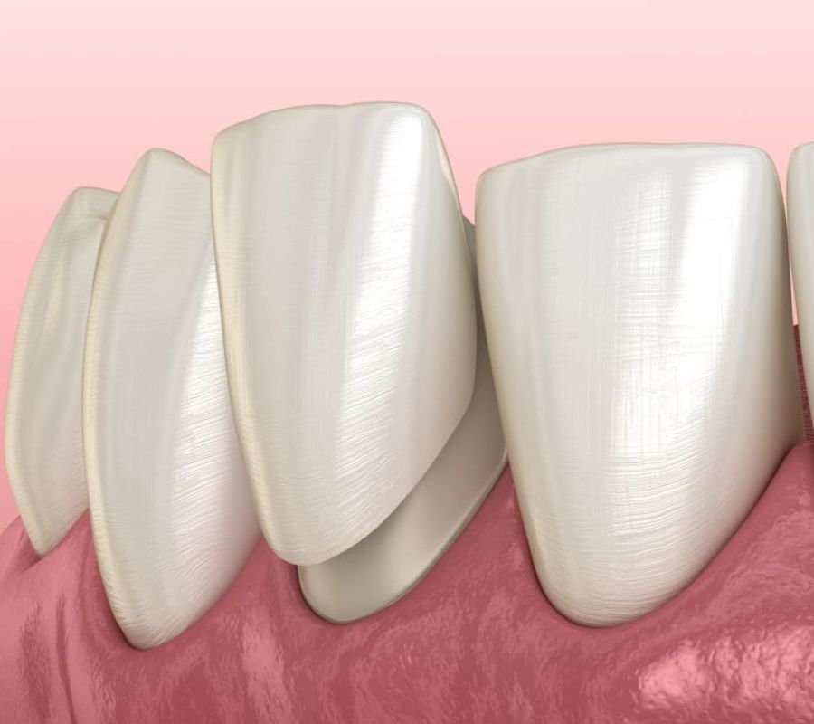 veneers